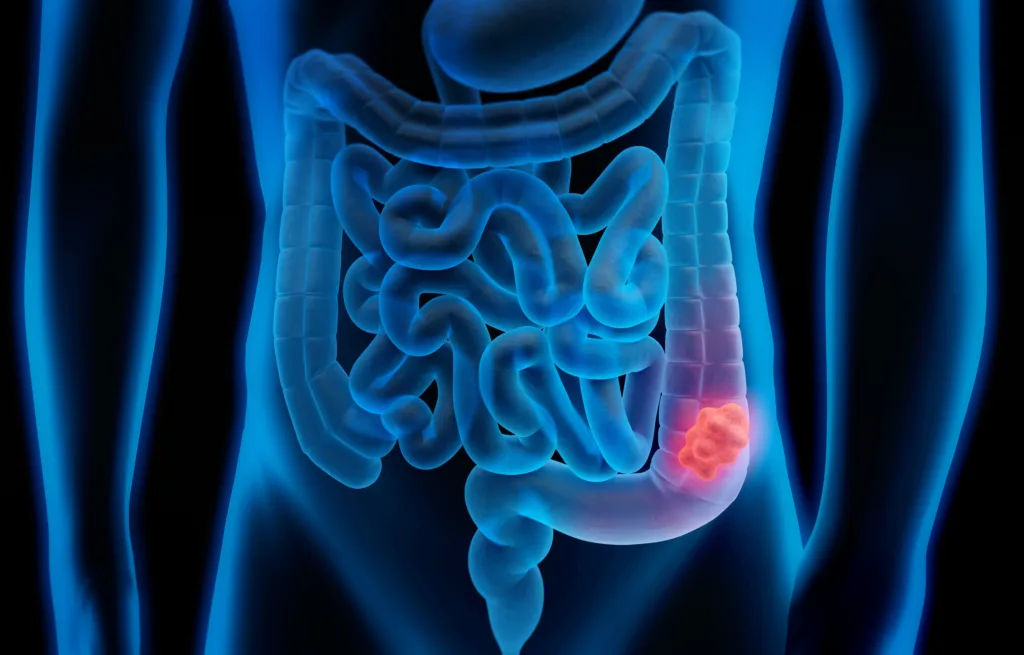 3d illustration of colon cancer - colon tumor