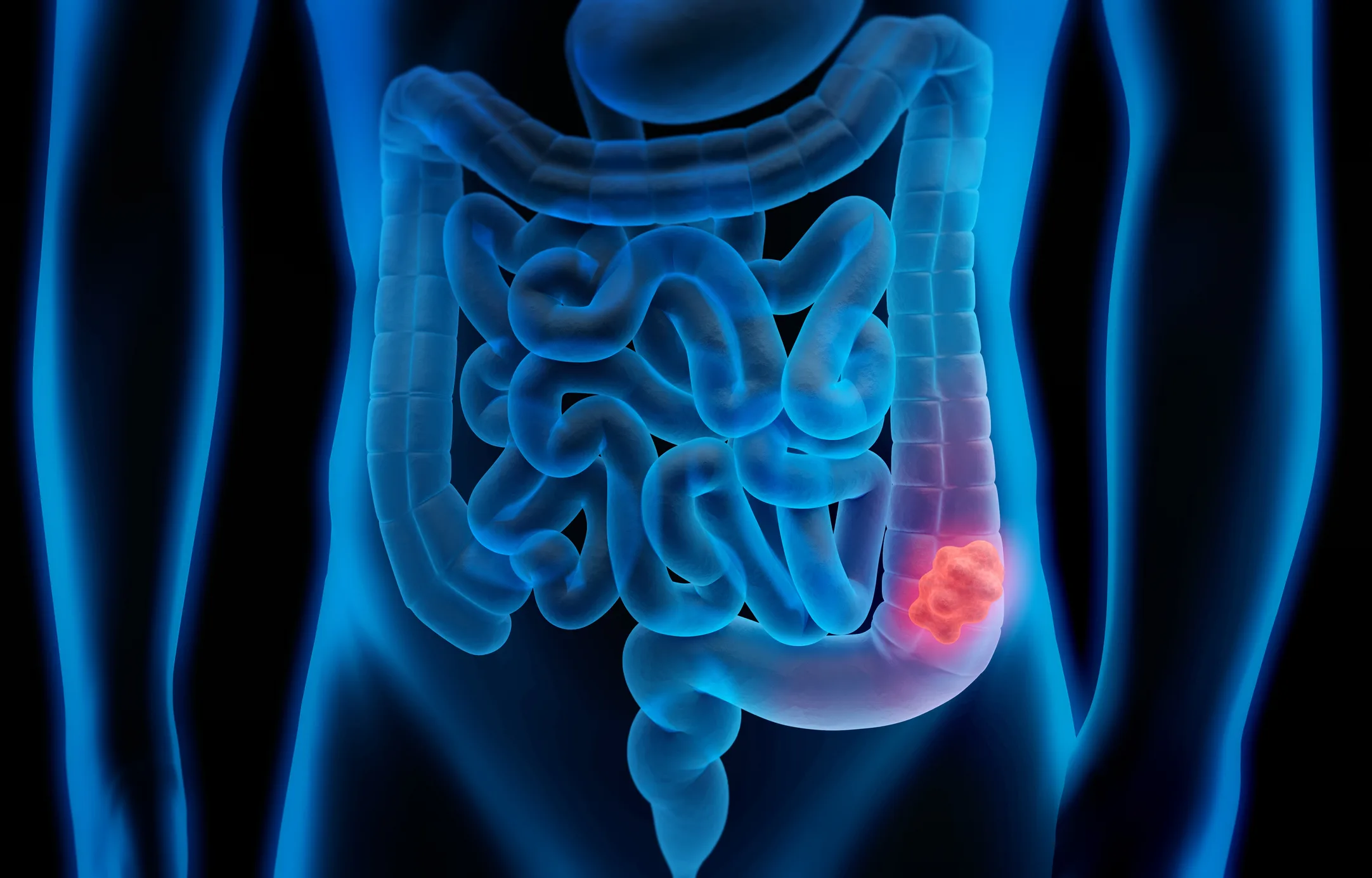 3d illustration of colon cancer - colon tumor