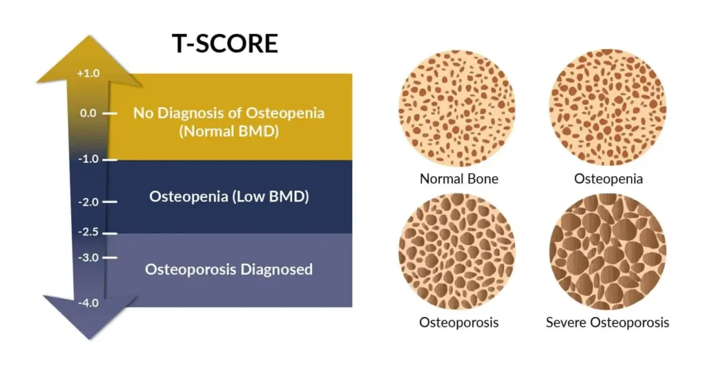 Diagram showing Osteopenia T-score and its relation to bone density