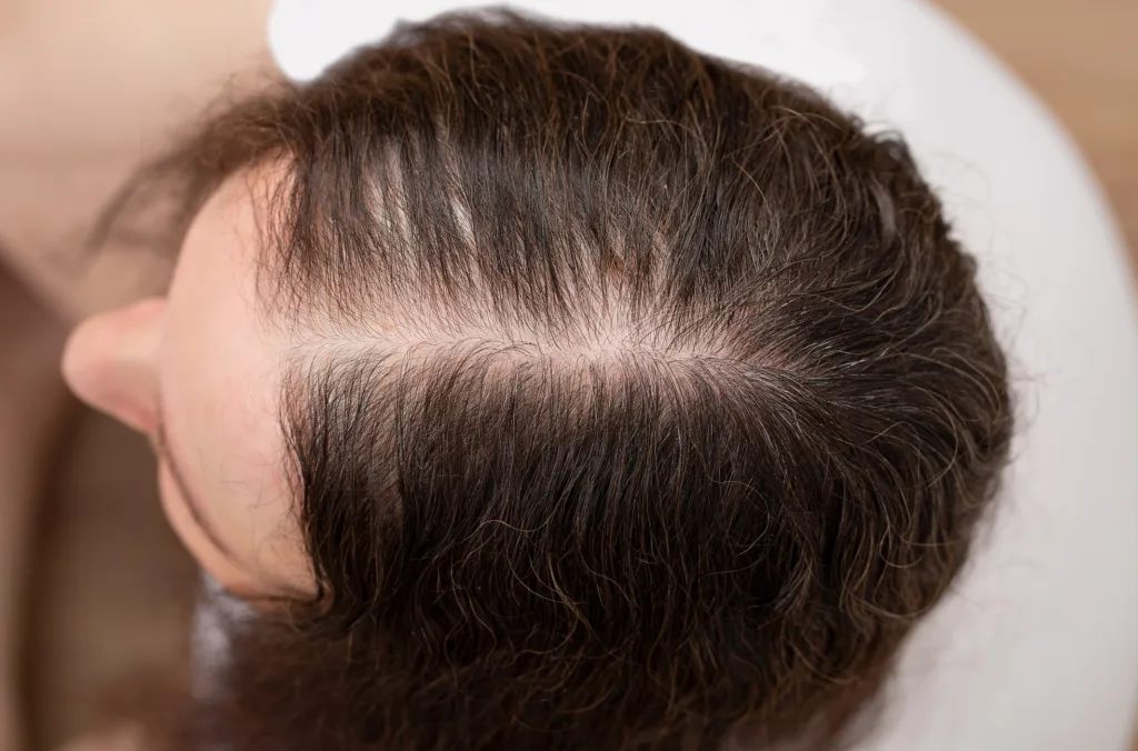 Top view of a woman with hair loss and no volume